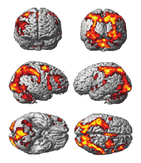 Hjernescanning - Hvordan nervesystemets trusselsvurdering påvirker dine smerter - Smertefribevægelse