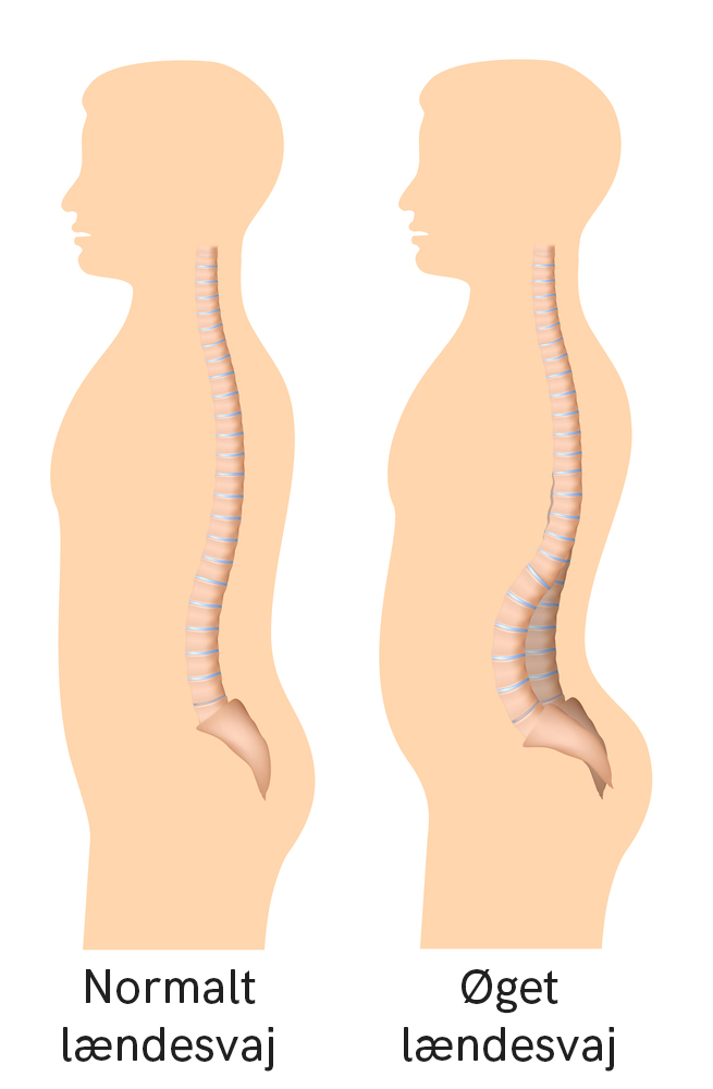 Normalt vs oget laendesvaj - Et nyt syn på lændesmerter - Smertefribevægelse