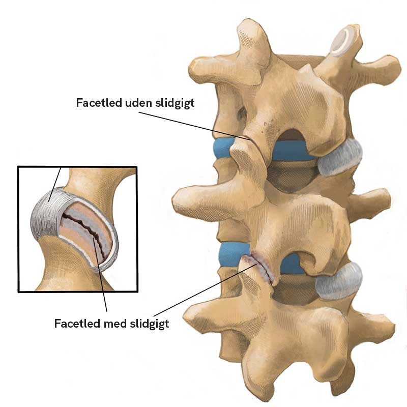 Facetled med slidgigt - Slidgigt i ryggen: Der er håb! - Smertefribevægelse