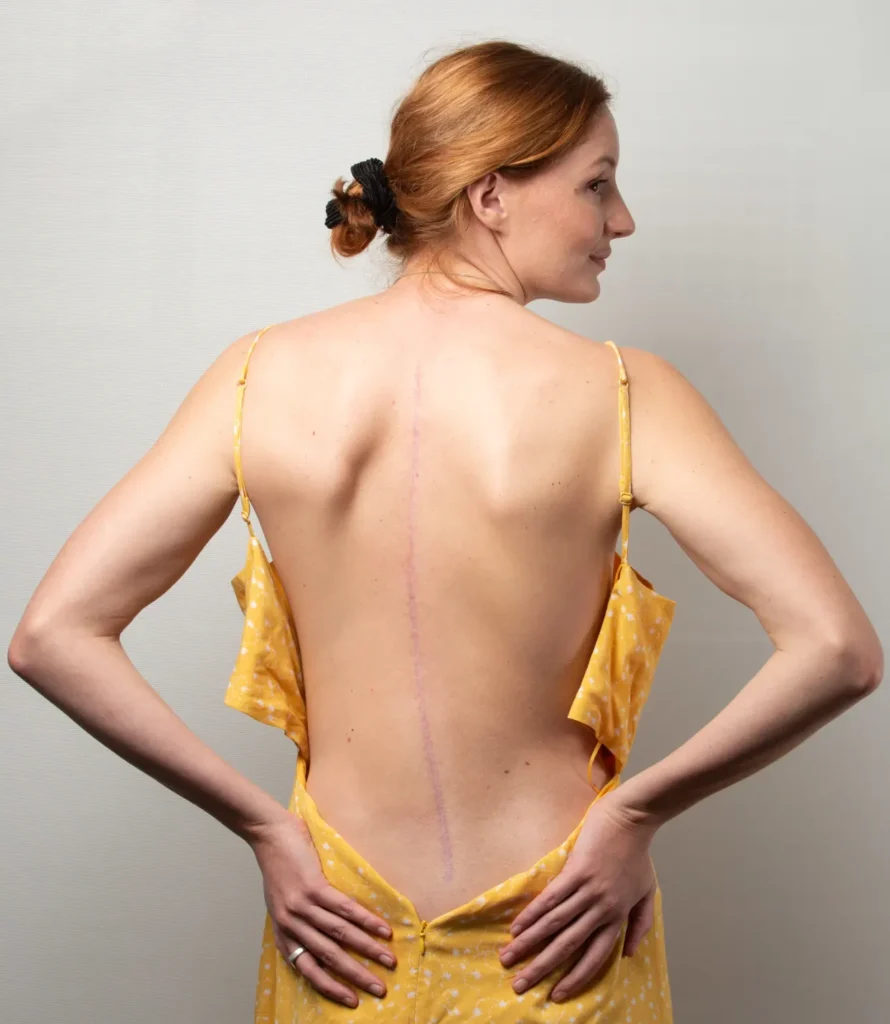Jessica Ashwood efter skoliose operation - Skoliose: Ingen hindring for et aktivt liv - Smertefribevægelse