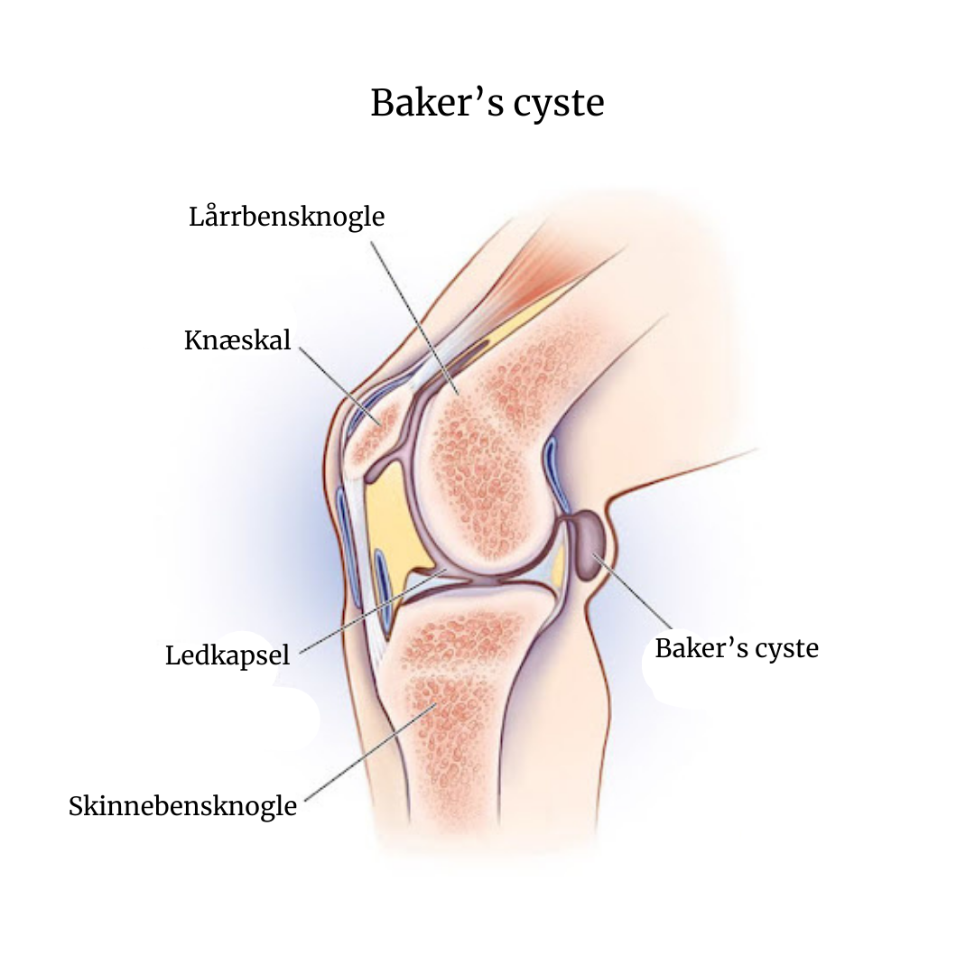 Her kan du se et billedet af et knæ med en Baker's cyste