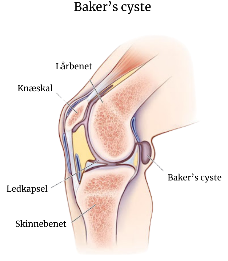 Bakers Cyste Anatomi e1727258747624 - Baker's cyste: Sådan kan du behandle det - Smertefribevægelse
