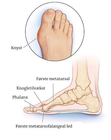 Et billedet af hallux rigidus