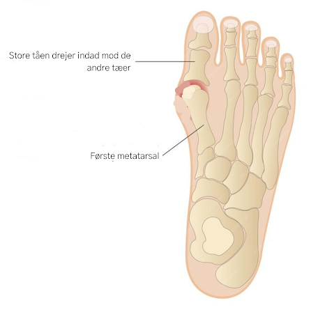 Et billedet af hallux valgus